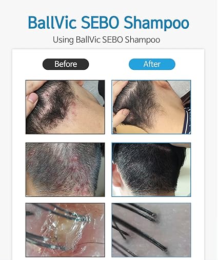 BallVic Sebo Shampoo – 17.6 oz | Korean Balancing Shampoo with Zinc & Herbal Complex